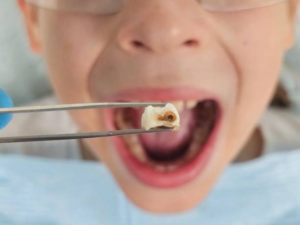 Best Emergency Root Canal Treatment in Steele Creek, AK